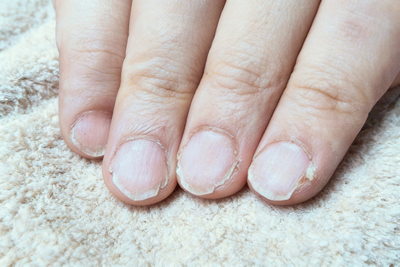 Nahaufnahme brüchiger Fingernägel mit sichtbaren Rissen, trockenen Nagelrändern und geschädigter Nagelhaut. Typisches Bild für brüchige, strapazierte Nägel.