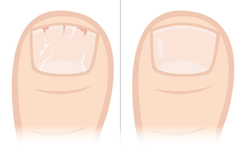 <p><strong>Brüchige Nägel —</strong> Ursachen erkennen und Nägel richtig pflegen</p>