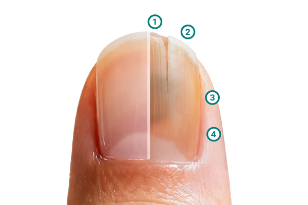 Grafik, die verschiedene Arten von Nagelschäden zeigt, darunter Absplitterungen, Risse, eine matte Oberfläche und Verfärbungen. Sie dient zur verständlichen Darstellung typischer Merkmale brüchiger Nägel.