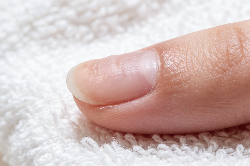 Nahaufnahme eines Fingernagels mit deutlich erkennbaren Dellen. Das Bild zeigt typische Unebenheiten des Nagels.