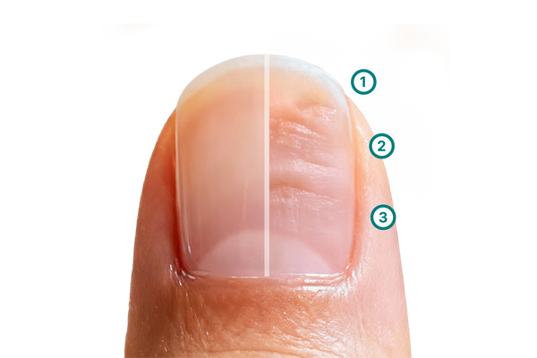 Grafik eines Fingernagels mit deutlich sichtbaren Dellen. Sie zeigt veränderte Oberflächenstrukturen, tastbare Unebenheiten und einen veränderten Nagelverlauf.