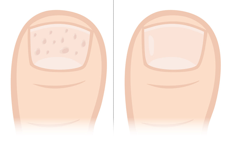 <p><strong>Dellen und Grübchen an Nägeln — </strong>Ursachen erkennen und richtig pflegen</p>