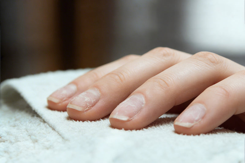 Nahaufnahme von geschwächten, dünnen Fingernägeln nach häufigem Nageldesign z. B. im Nagelstudio. Das Bild zeigt eine sichtbare Ausdünnung der Nagelplatte.