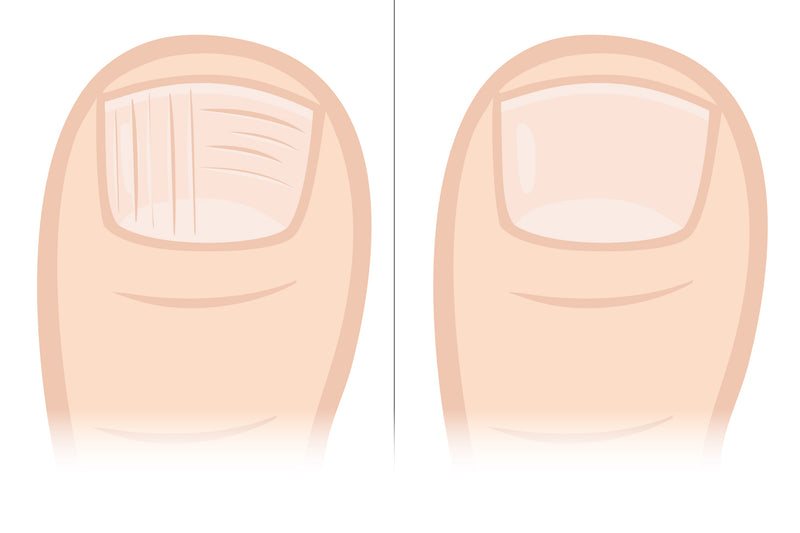 <p><strong>Längs- und Querrillen an Nägeln </strong>—  Ursachen und wirksame Pflege</p>