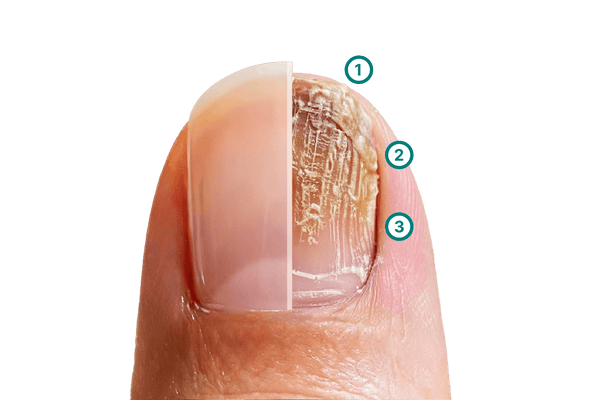 Grafik zum Vergleich zwischen natürlicher und verdickter Nageloberfläche: Dargestellt sind typische Strukturveränderungen wie erhöhte, kompaktere Keratinschichten und eine sichtbar massivere Nagelplatte. Die Illustration zeigt, wie ungleichmäßiger Aufbau oder zusätzliche Hornauflagerungen das Erscheinungsbild verdickter Nägel beeinflussen.