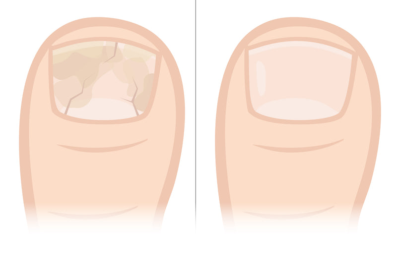 <p>Verdickte und verfärbte Nägel: Behandeln und wirksam vorbeugen</p>