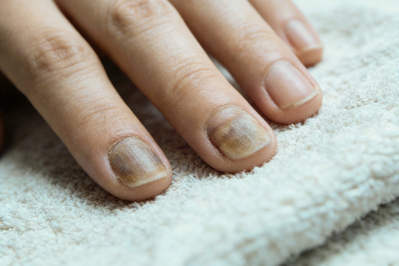 <p>Verfärbte Nägel: Woher sie kommen und was dagegen hilft</p>