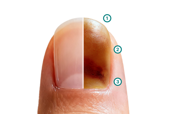 Grafik zum Vergleich zwischen natürlicher und verfärbter Nageloberfläche: Dargestellt sind typische Farbabweichungen wie gelbliche und bräunliche Töne, die sich über die Nagelplatte verteilen. Die Illustration zeigt, wie sich eingelagertes Pigment oder optische Veränderungen der Nagelplatte auf den sichtbaren Nagelton auswirken.